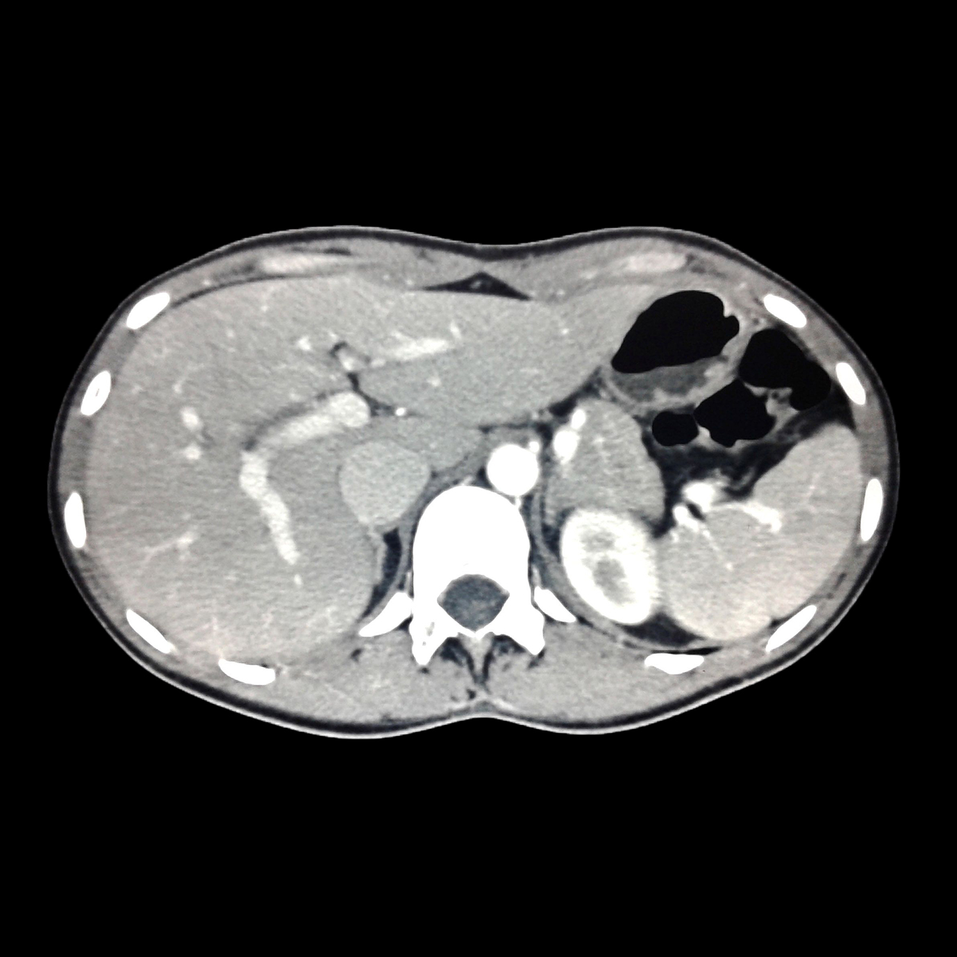 Tomografía abdominal y angiotem para evaluación vascular y órganos internos