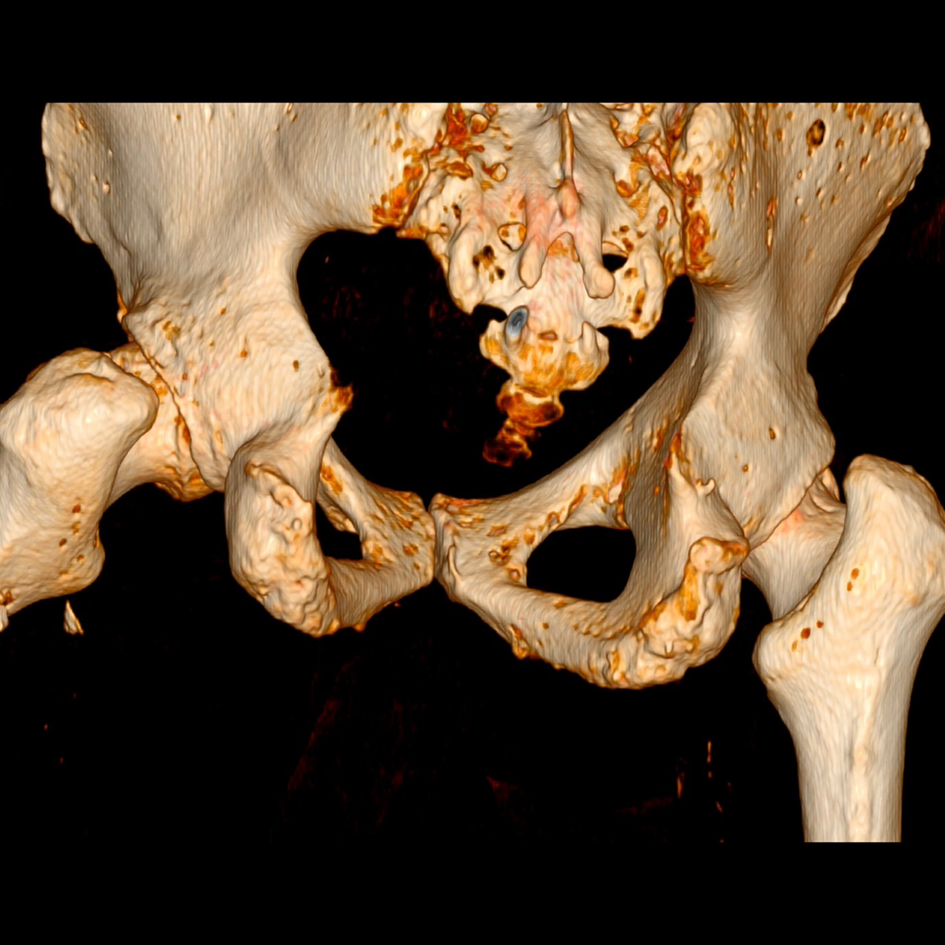 Tomografía de cadera para evaluación articular y estructural