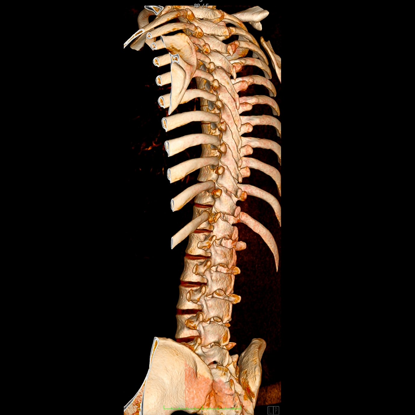 Tomografía de columna para evaluación de la estructura vertebral