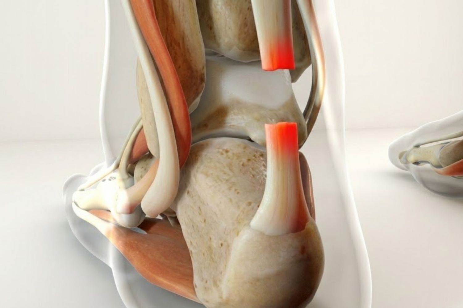 Cirugía de Tendón de Aquiles en Lima