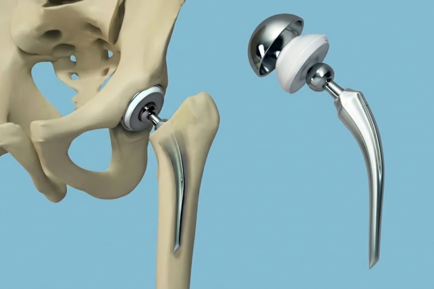 Cirugía de Prótesis de Cadera Clínica GSTAR